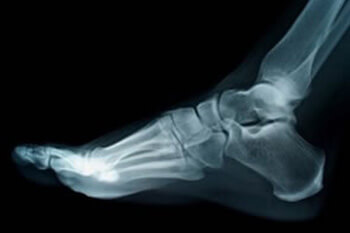 foot x-ray