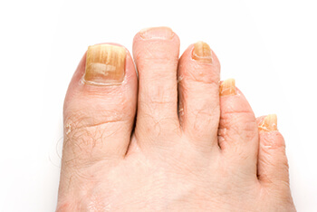 Toenail fungus treatment and restoration in the Honolulu County, HI: Honolulu (Manoa, Kaneohe, Waikiki, Aiea, Waimalu, Moanalua, Kailua, Maunawili, Pearl City, Waipahu, Ahuimanu, Hawaii Kai, Waialae - Kahala) and North Shore (Kahuku, Laie, Hauula, Kawela Bay, Pupukea, Punaluu, Kaaawa, Haleiwa, Waialua, Koolauloa) areas